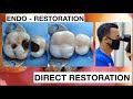 Dental Filling Procedure from Endodontic to Restoration Composite | General Dentist Griya RR