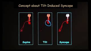 Adult Dysautonomias Part 1: Syncope (18 of 24)