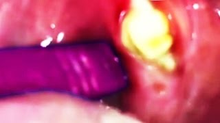 Extreme Tonsil Stone Removal!