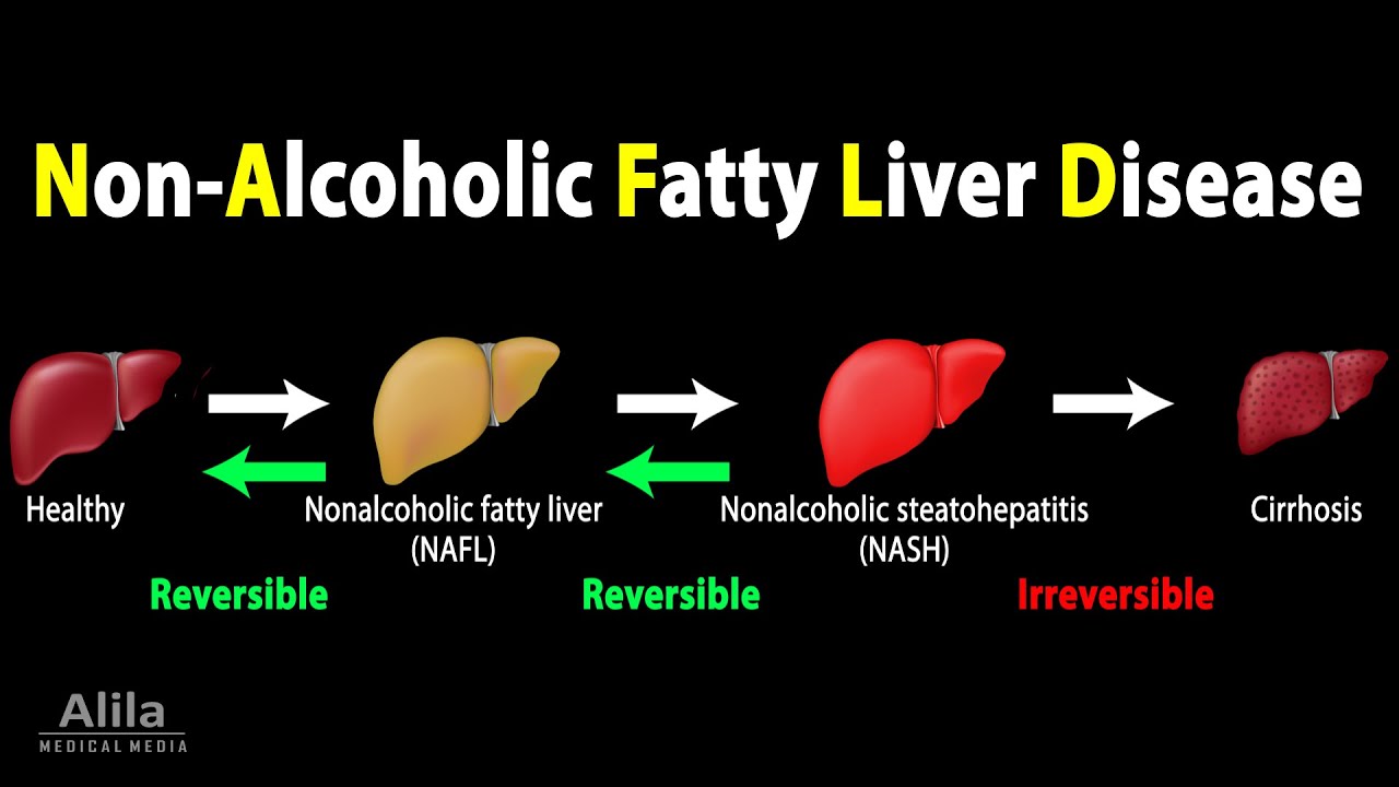 Nonalcoholic Fatty Liver Disease (NAFLD), Animation - YouTube