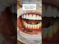 Dental Veneers composite veneers vs. porcelain veneers #dentalveneers #shorts #cosmeticdentistry