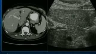 What’s New in Abdominal Biopsy and Drainage