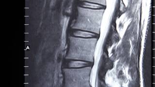 Orthopedic Surgeon Dr. Benjamin Rentfrow - Back Pain
