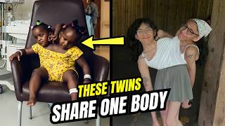 13 Real Conjoined Twins That Shocked the World | Rare Human Conditions
