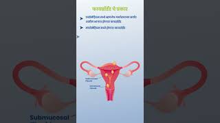 Pregnancy with Fibroids | Treatments for Fibroids | Types of Fibroids | Progenesis IVF