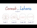 Cormak-Lehane Classification (Grades) for Airway Management and Endotracheal Intubation