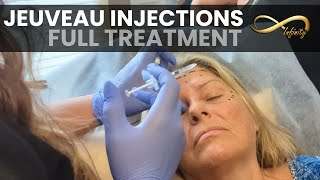 Jeuveau Treatment | Neurotoxin Injections at Infinity MedSpa