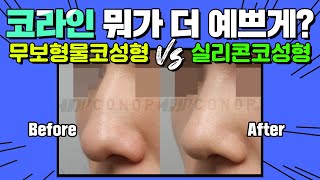 무보형물코성형 vs 실리콘코성형 뭘 해야할지 모르겠다면 꼭 보세요!  - 코노피