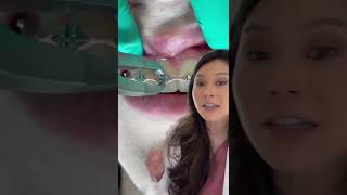 How Braces Brackets are Removed - so easy! #dentist #braces #brackets