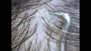 Dandruff Under a Microscope!