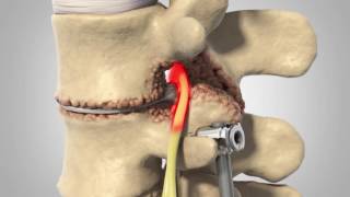Adjacent Segment Disease - Patient Animation