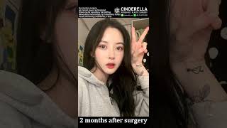 [Plastic Surgery][Plastic Surgery Korea] Do you want a amazing change?! #shorts