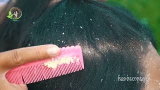 She scratch dandruff look so interested 2189