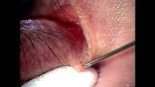 眼皮粟粒腫挑除 extirpation of milia cyst over lid