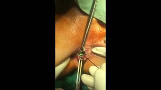 Laser treatment for Piles - The Chennai Laser Gastro Clinic, T Nagar | Piles treatment in chennai