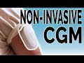 Are Non-Invasive CGMs the Future?