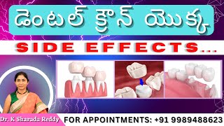 డెంటల్ క్రౌన్యొ యొక్క SIDE EFFECTS ? | by Dr. K Sharada Reddy in telugu #dentalcrownadvantages