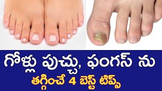 గోళ్ళు పుచ్చు ఫంగస్ ను తగ్గించే 4 చిట్కాలు|How to prevent \u0026 treat nail fungus|Nailfungushomeremedies