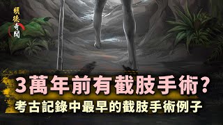 驚人 3萬年前人類竟有精湛截肢手術