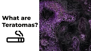 What are teratomas?| Explained| Cancer Biology