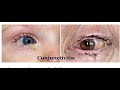 Painless Red Eye DD; (Infective Conjunctivitis)#Ziada eye academy# for UG & PG