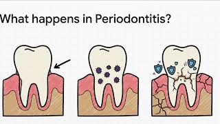Why Do My Gums Bleed And How to Stop It