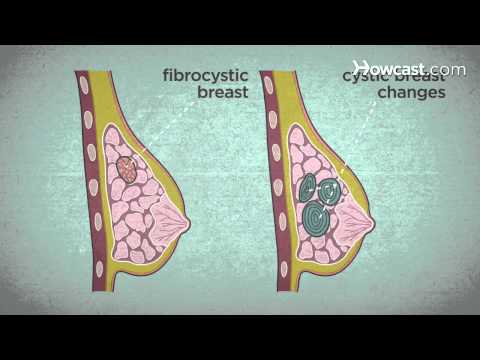 How to Recognize Breast Cancer Symptoms How to Recognize Breast Cancer Symptoms