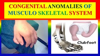 CONGENITAL ANOMALIES OF MUSCULO SKELETAL SYSTEM  - classification , pathophysiology , management