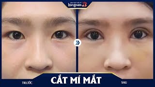 Cắt mí mắt trên + Mở góc mắt trong sau 7 ngày đã đẹp chưa?