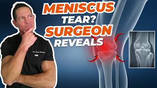 Do Meniscus Tears Always Need Surgery? | Orthopedic Surgeon Reveals