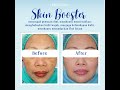 Skin Booster by Dermakila Clinic