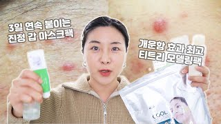 자극NO 효과 굿!!! 데일리로 쓰는🔥 여드름 진정 추천템 5가지 소개해요