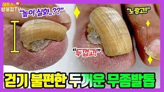 두꺼운 무좀발톱! 너무 아파서 걷기 힘들정도였는데 한방에 고민해결^^ 자르기힘들었던 공룡발톱 스케일링! #레푸스 #조갑구만증 #thicktoenail