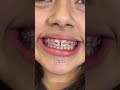 braces colors for whiter looking teeth