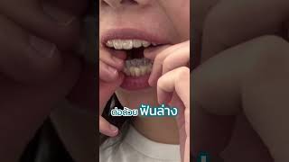 How to ใส่ชิ้นงานจัดฟันใส Invisalign