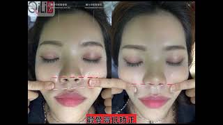 麒力整骨立体小颜矫正术 3D Face Make 脸型矫正缩小