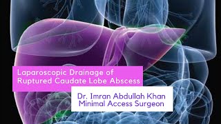 Laparoscopic Drainage of Ruptured Liver Abscess | Liver Abscess Surgery | Dr. Imran Abdullah Khan