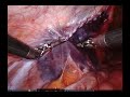 robotic repair of left spigelian hernia