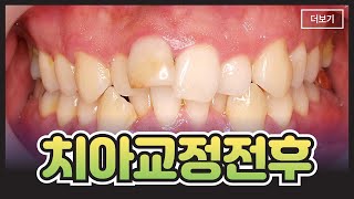 정말 드라마틱한 치아교정 전후 영상