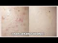 REVIEW JUJUR PRODUK JERAWAT! BENERAN SEMBUH SEJAK HARI KE-3, ERHA ACNEACT SPOT GEL - Willy Puspita