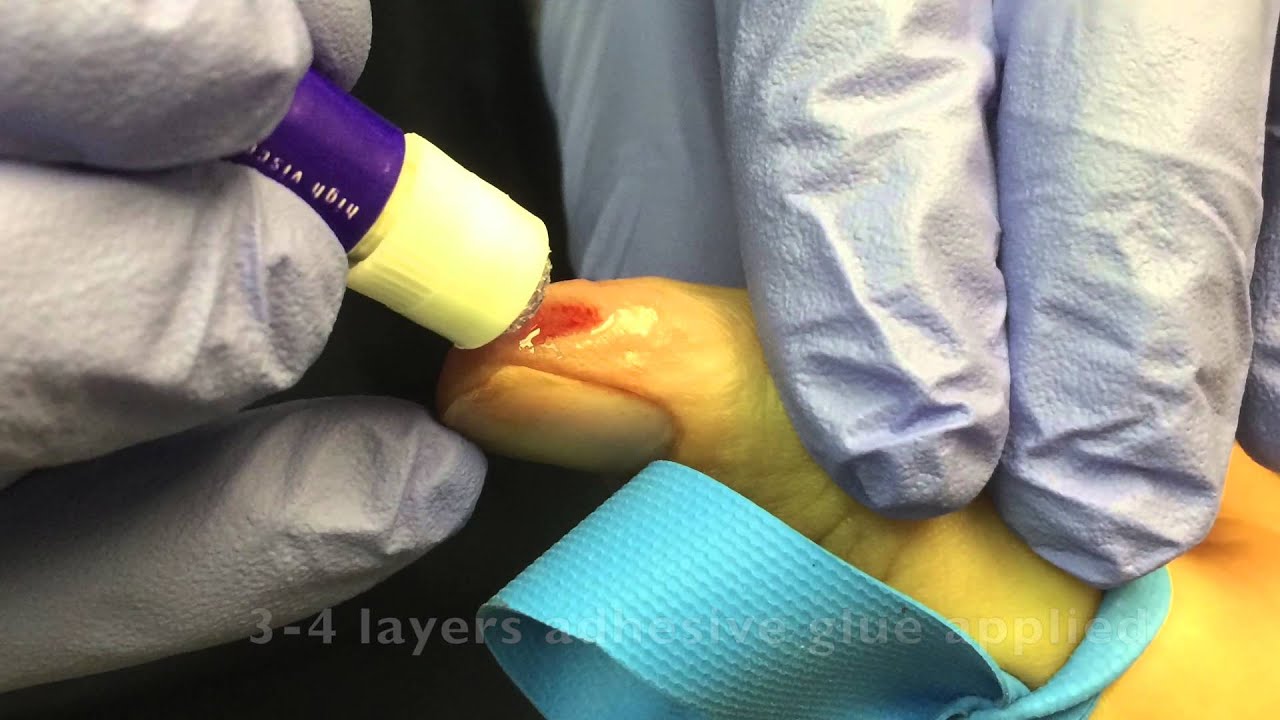 Nail Bed Laceration Repair With Dermabond - Nail Ftempo