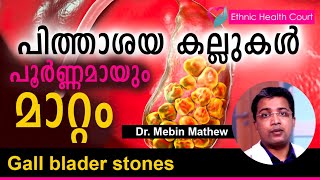 Gallblader stones - Treatments | പിത്താശയ കല്ലുകൾ എങ്ങനെ പൂർണ്ണമായും മാറ്റം ? | Ethnic Health Court