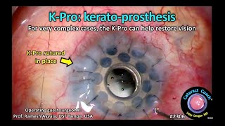 CataractCoach™ 2306: K-Pro kerato-prosthesis for very complex cases