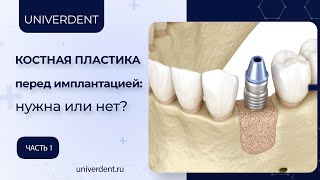 Костная пластика перед имплантацией зубов: нужна или нет? Часть 1.