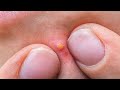 Satisfying Blackhead Removal | Ultimate Nose Extraction Compilation