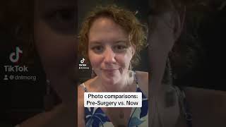 Photo Comparisons: Pre-Surgery vs. Now