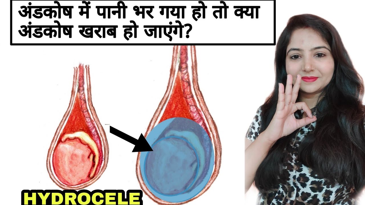 HYDROCELE - YouTube