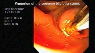 Endoscopic treatment of biliary acute pancreatitis