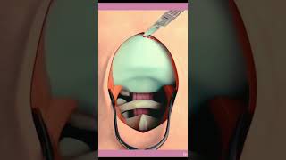 surgery  animation video #memes #follow #funny #viral #events #photography #explorepage #movies