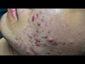 Inflammatory acne, yellow acne, blackheads - Acne Treatments Mai Ngoc 💕💕💕